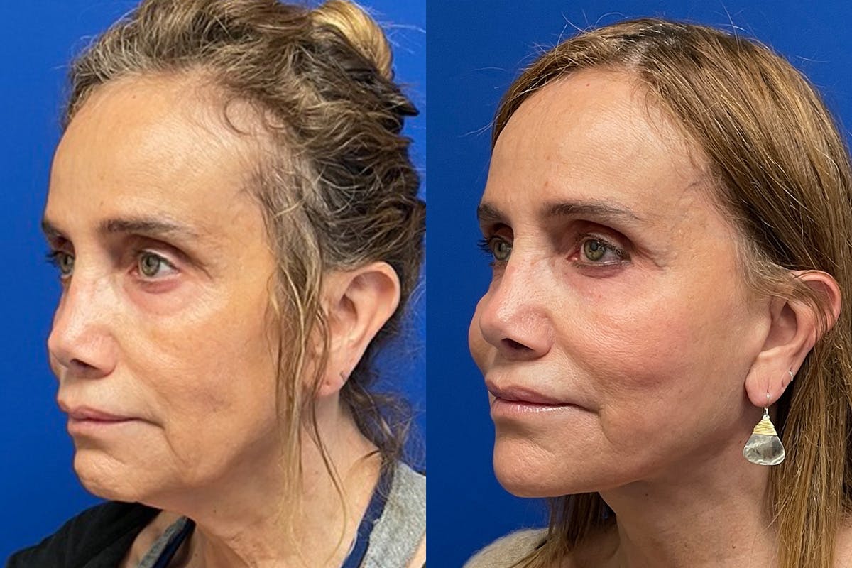 Facelift Before & After Gallery - Patient 176639 - Image 3