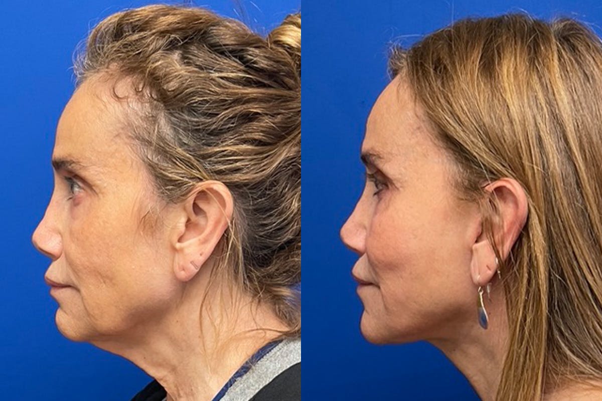 Facelift Before & After Gallery - Patient 176639 - Image 4