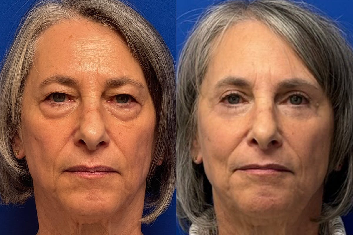 Eyelids Before & After Gallery - Patient 131459 - Image 1