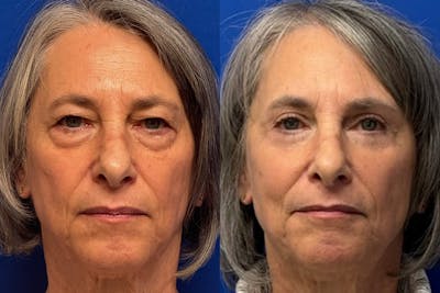 Eyelids Before & After Gallery - Patient 131459 - Image 1