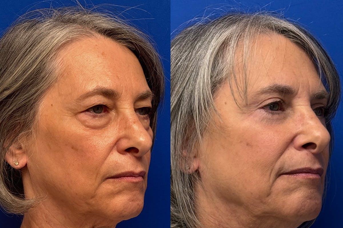 Eyelids Before & After Gallery - Patient 131459 - Image 2