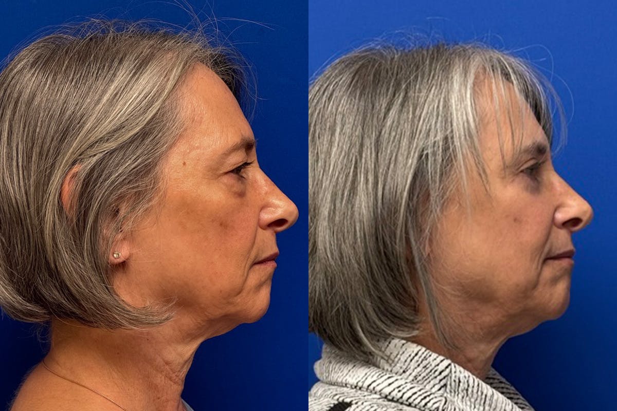 Eyelids Before & After Gallery - Patient 131459 - Image 3