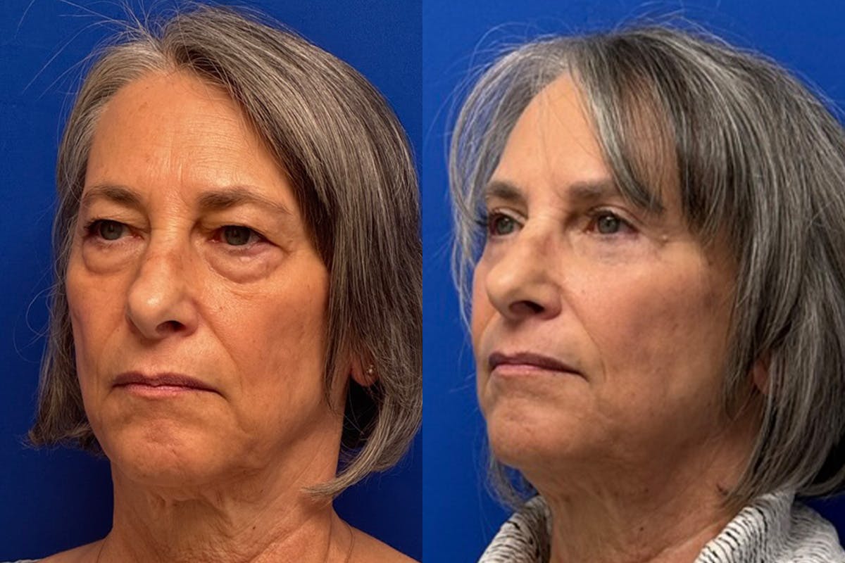 Eyelids Before & After Gallery - Patient 131459 - Image 4