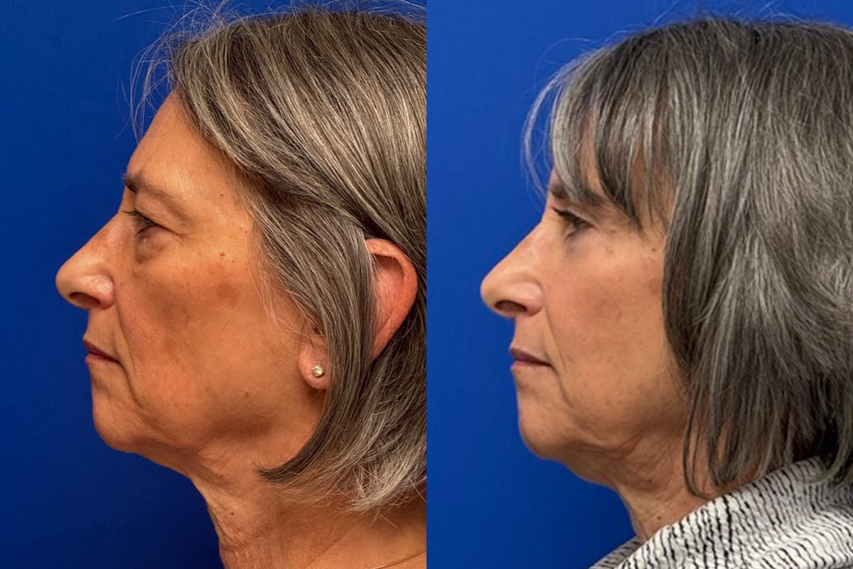 Eyelids Before & After Gallery - Patient 131459 - Image 5