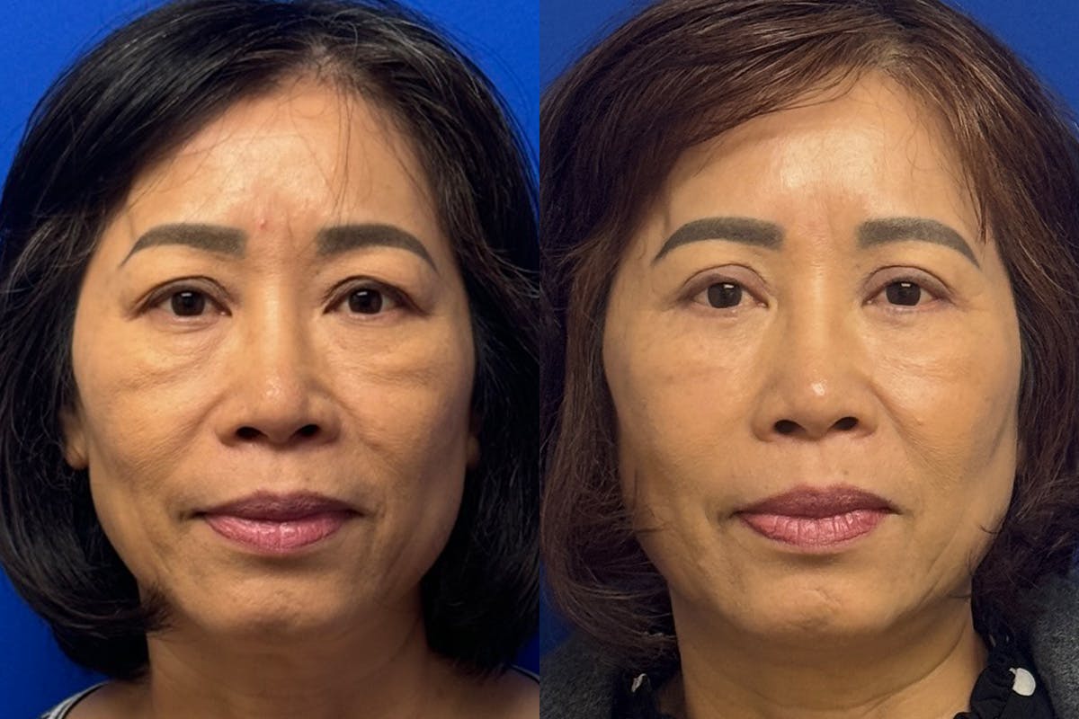 Eyelids Before & After Gallery - Patient 407262 - Image 1