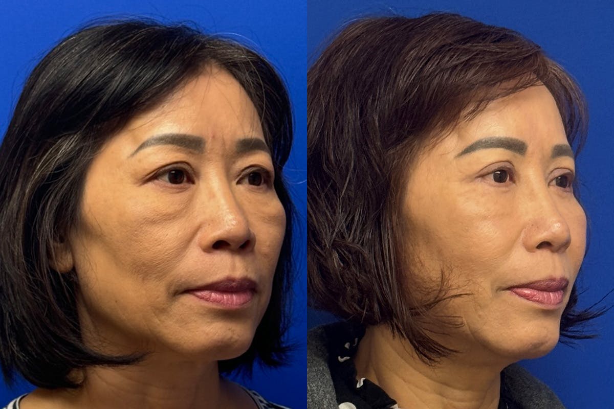 Eyelids Before & After Gallery - Patient 407262 - Image 2