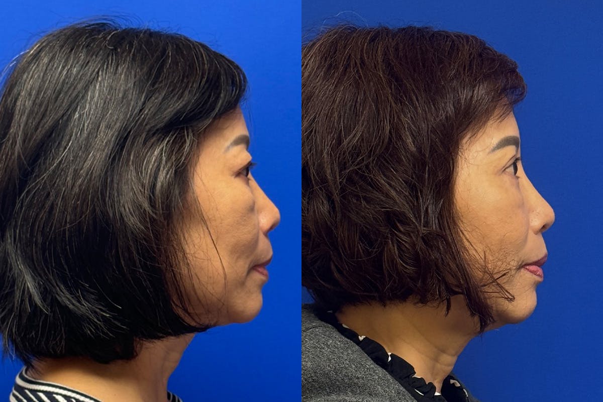 Eyelids Before & After Gallery - Patient 407262 - Image 3