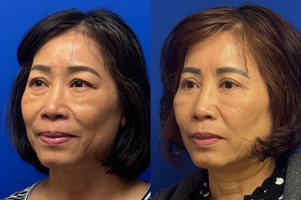 Eyelids Before & After Gallery - Patient 407262 - Image 4