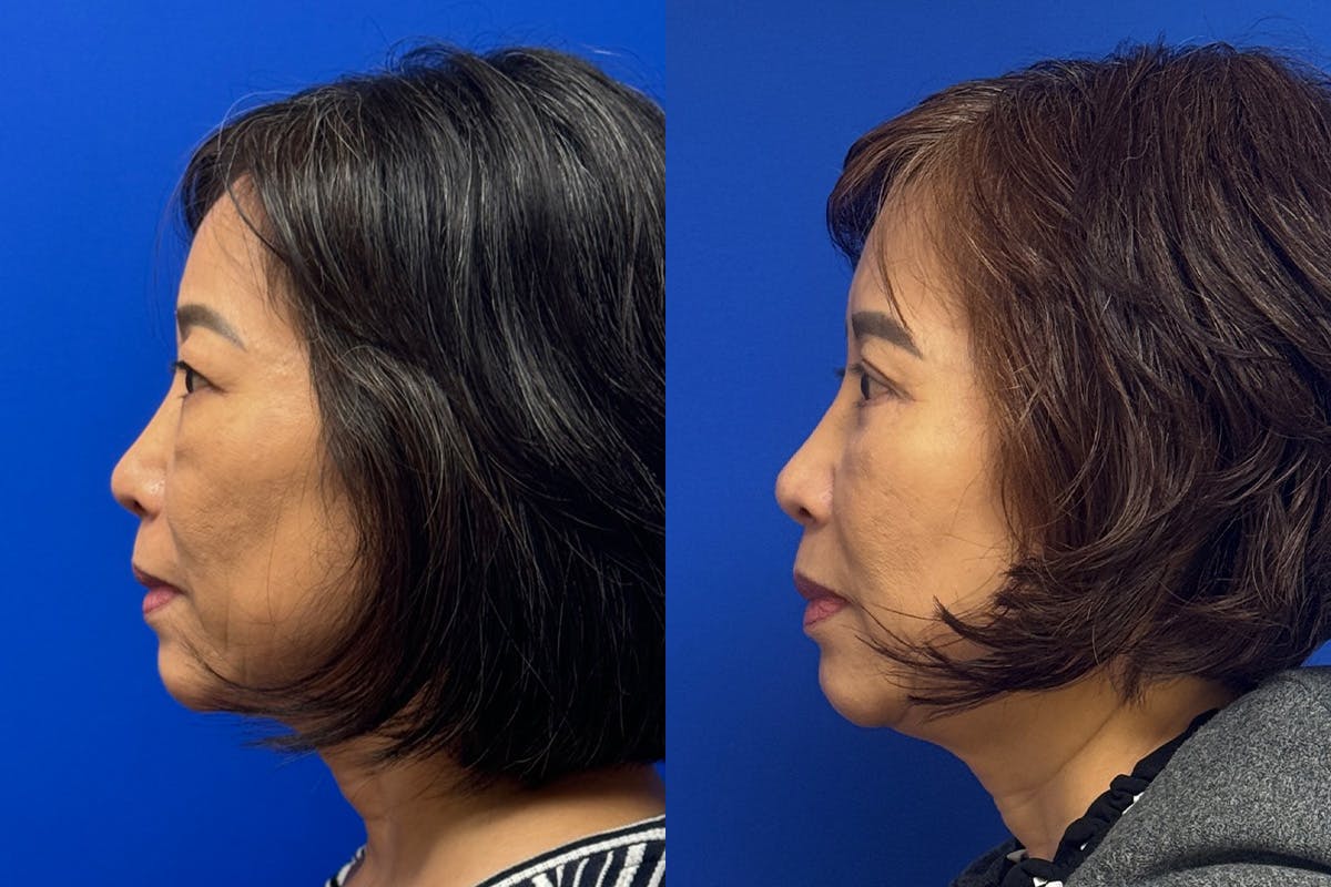 Eyelids Before & After Gallery - Patient 407262 - Image 5