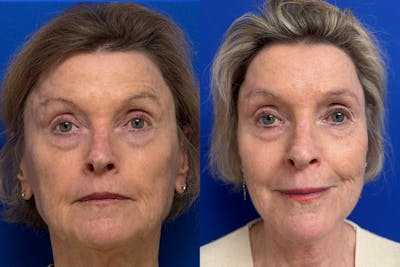 Facial Contouring / Submental Lipo Before & After Gallery - Patient 630859 - Image 1