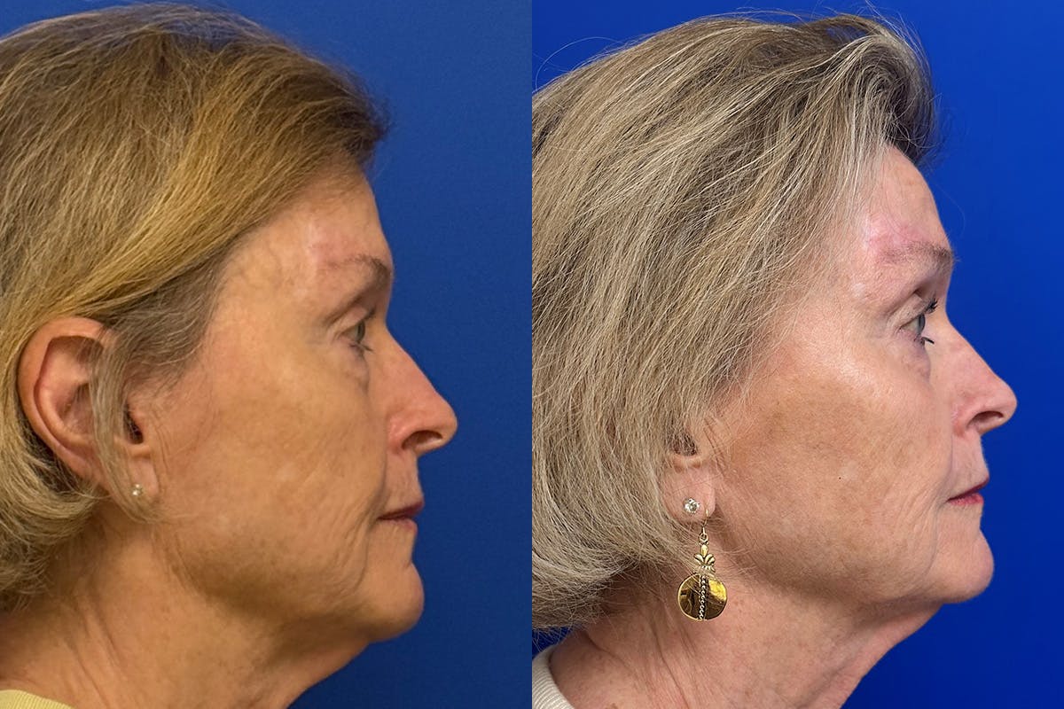Facial Contouring / Submental Lipo Before & After Gallery - Patient 630859 - Image 3