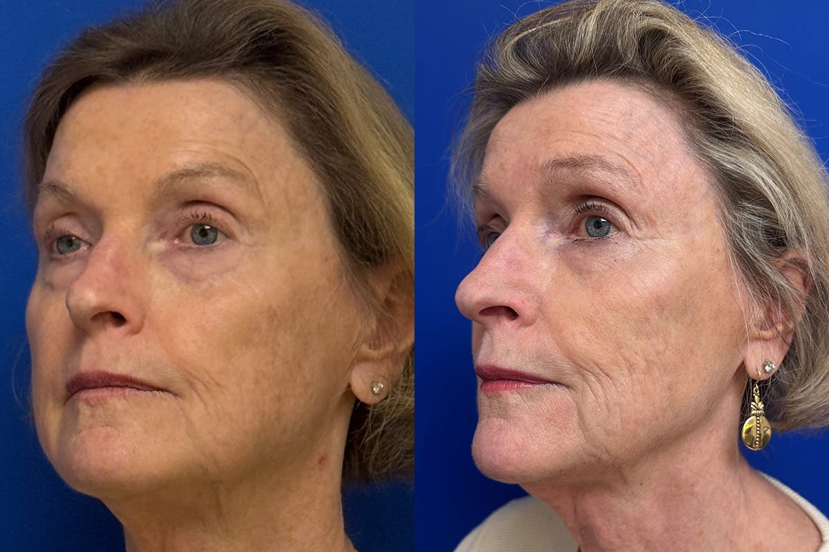 Facial Contouring / Submental Lipo Before & After Gallery - Patient 630859 - Image 4