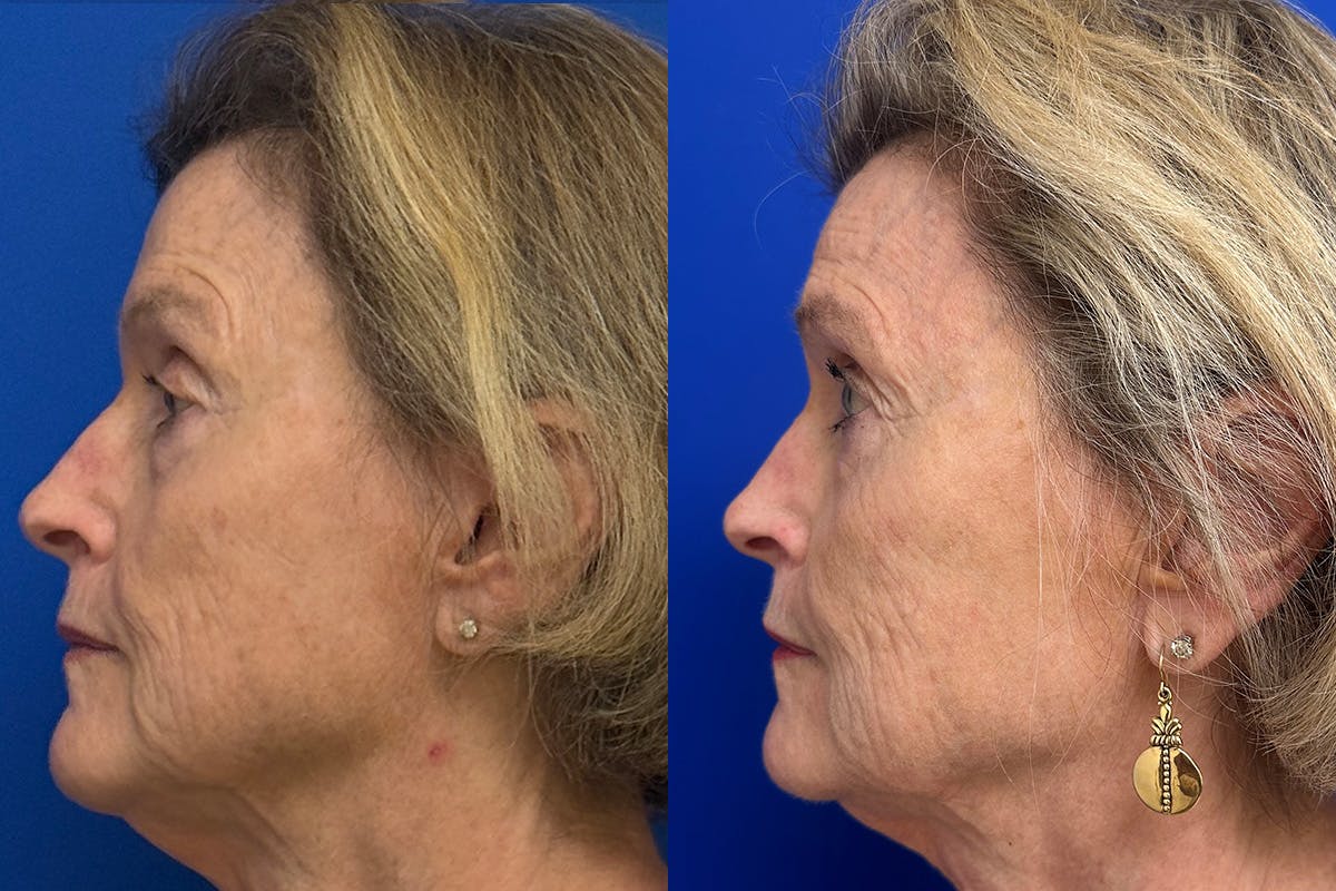 Facial Contouring / Submental Lipo Before & After Gallery - Patient 630859 - Image 5