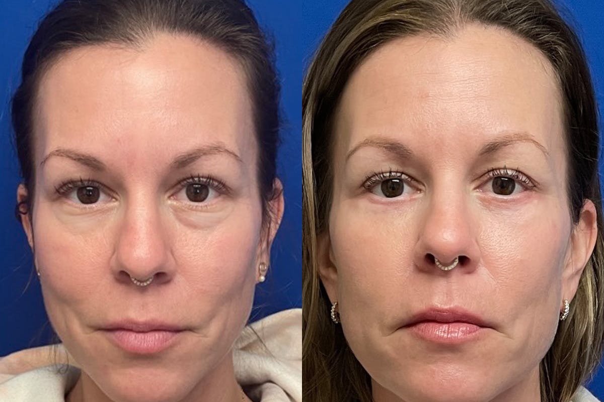 Eyelids Before & After Gallery - Patient 307671 - Image 1