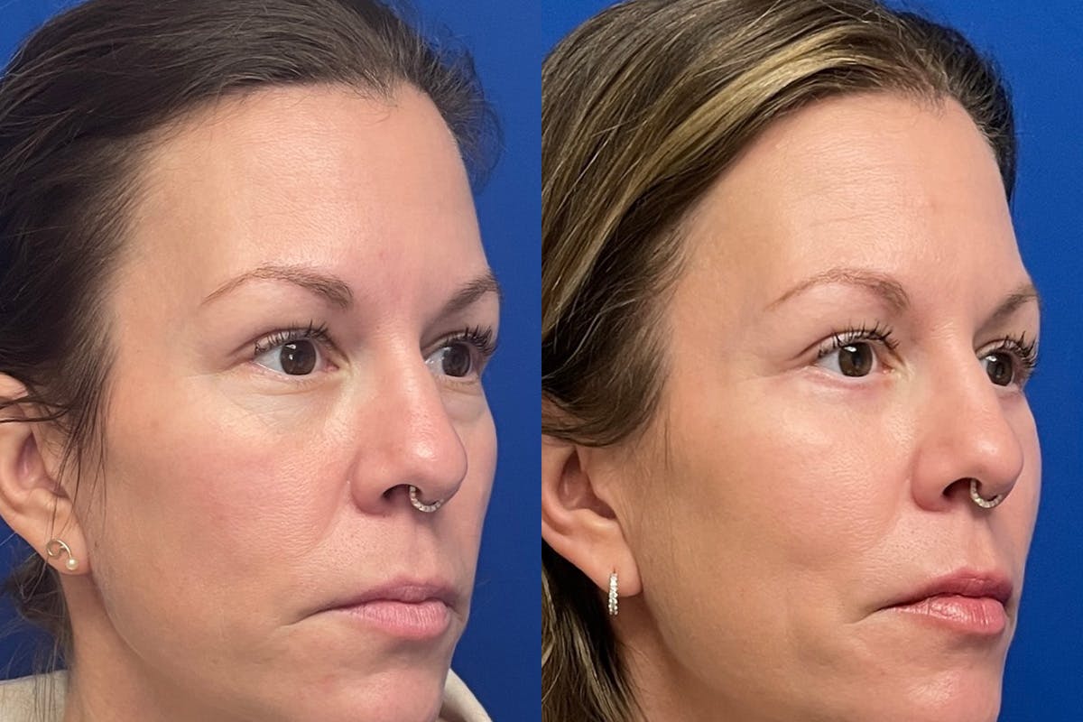 Eyelids Before & After Gallery - Patient 307671 - Image 2