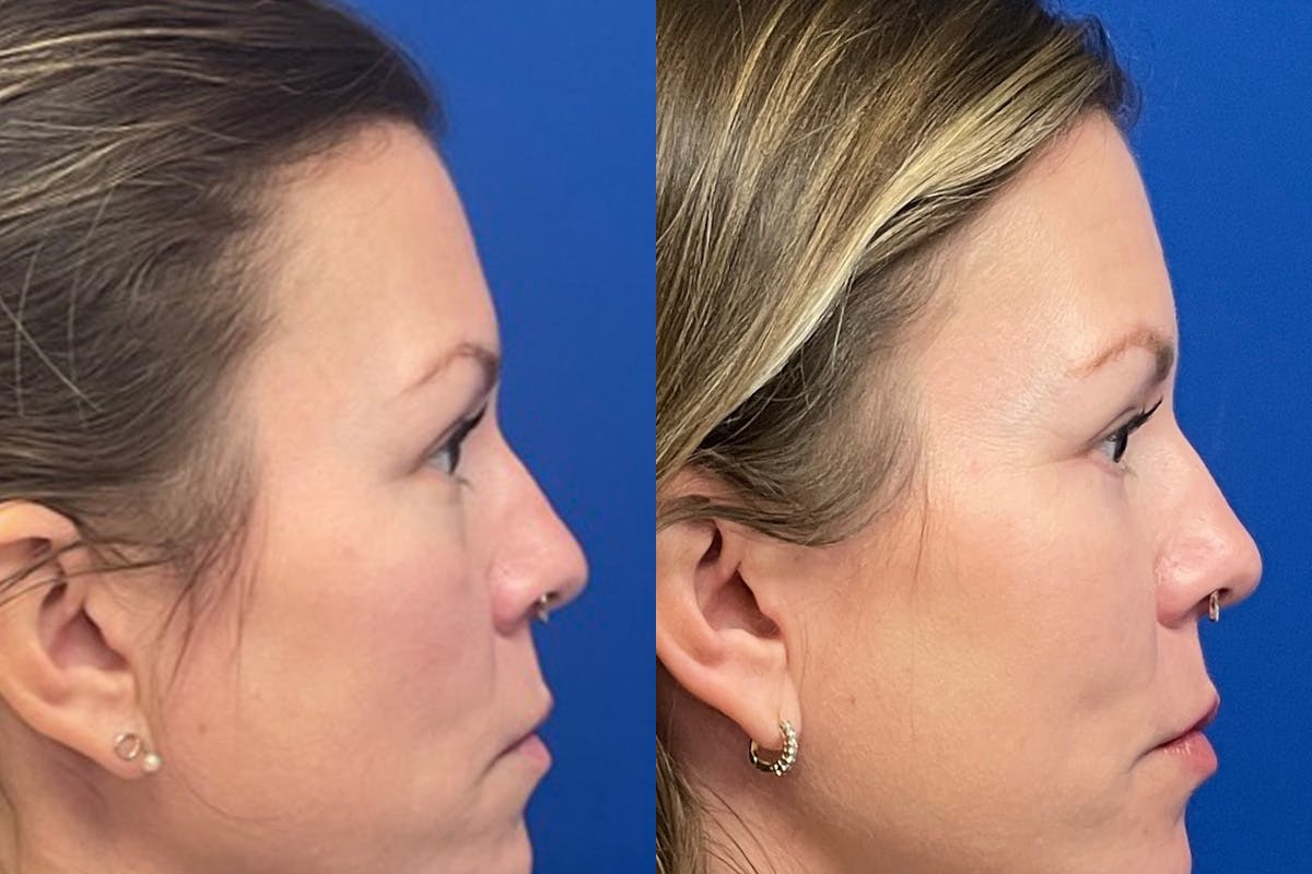 Eyelids Before & After Gallery - Patient 307671 - Image 3