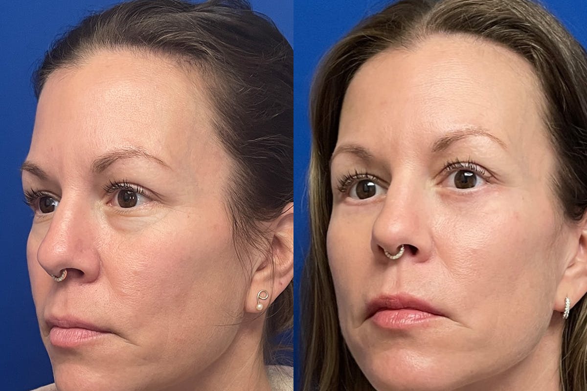 Eyelids Before & After Gallery - Patient 307671 - Image 4
