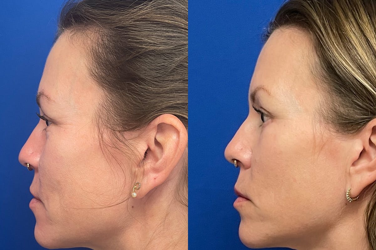 Eyelids Before & After Gallery - Patient 307671 - Image 5