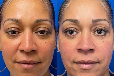 Eyelids Before & After Gallery - Patient 709967 - Image 1