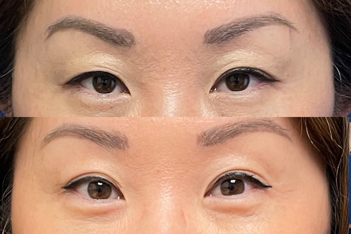 Eyelids Before & After Gallery - Patient 405888 - Image 3