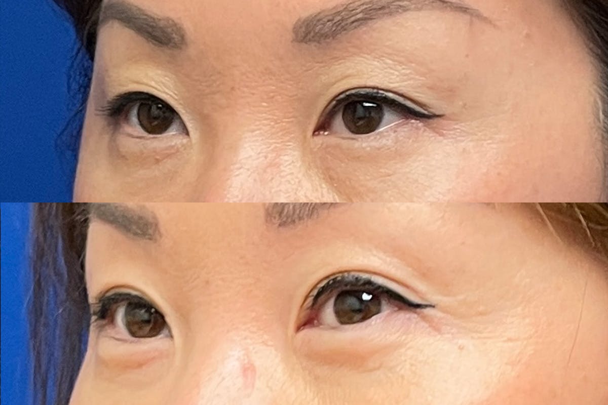 Eyelids Before & After Gallery - Patient 405888 - Image 1