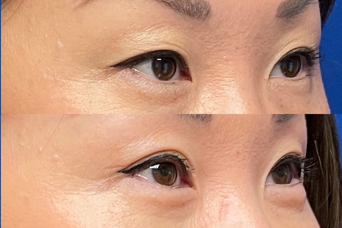 Eyelids Before & After Gallery - Patient 405888 - Image 2