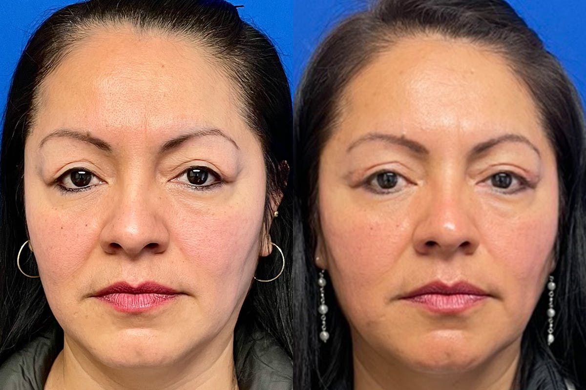 Eyelids Before & After Gallery - Patient 397132 - Image 1