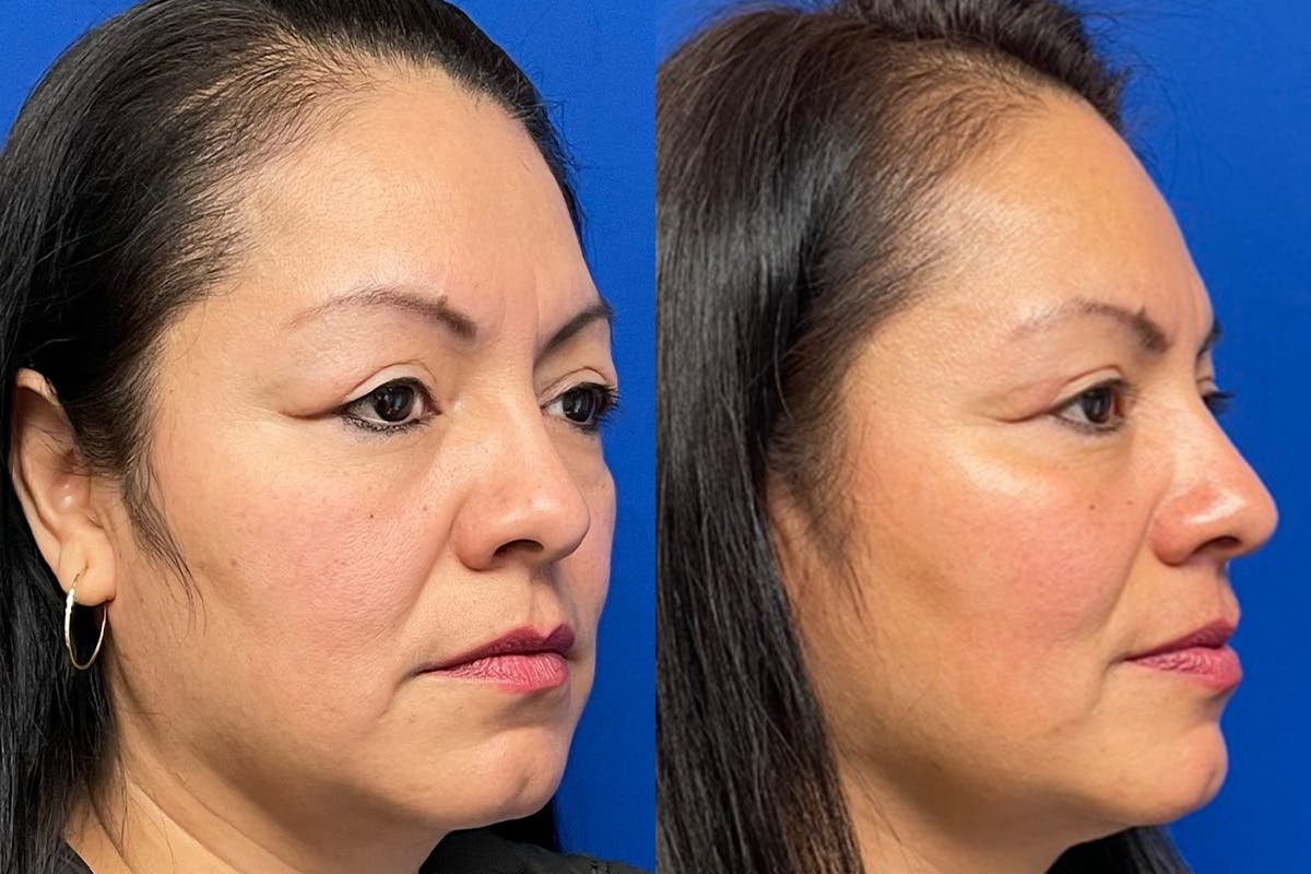 Eyelids Before & After Gallery - Patient 397132 - Image 2
