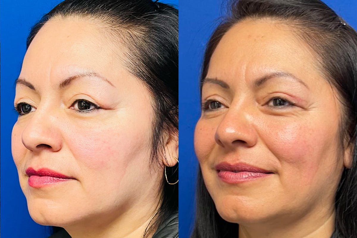Eyelids Before & After Gallery - Patient 397132 - Image 3
