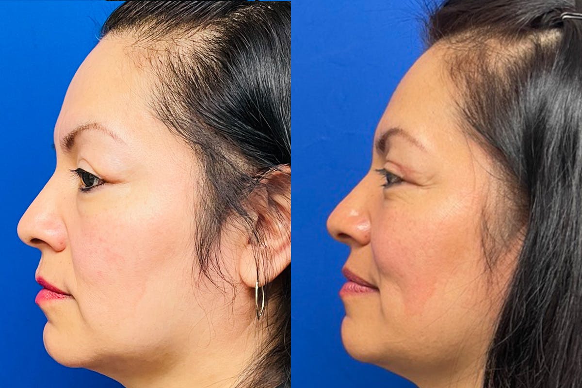 Eyelids Before & After Gallery - Patient 397132 - Image 4