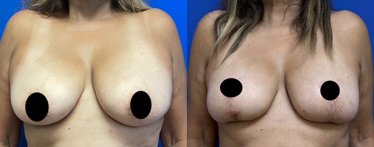 Breast Lift Before & After Gallery - Patient 144226 - Image 1
