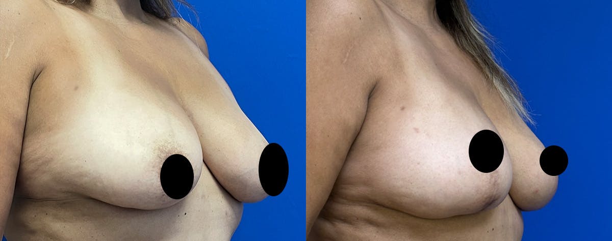 Breast Lift Before & After Gallery - Patient 144226 - Image 2