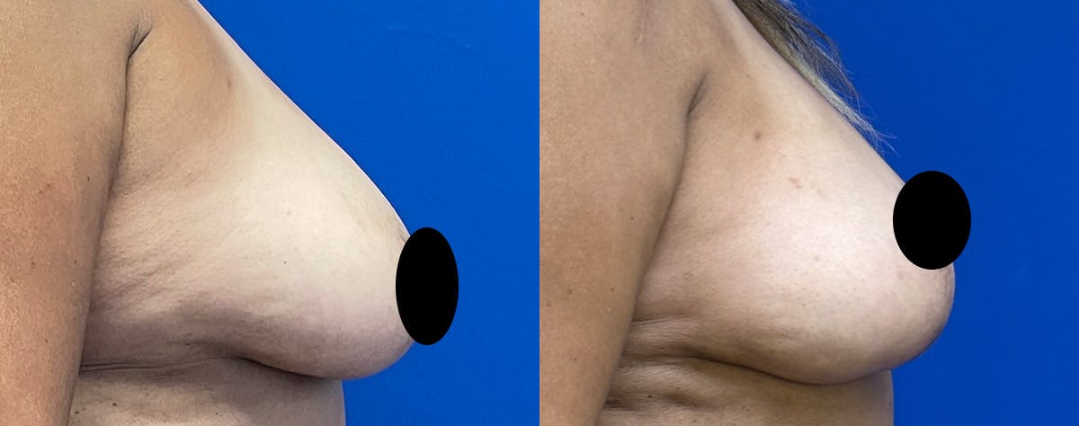 Breast Lift Before & After Gallery - Patient 144226 - Image 3