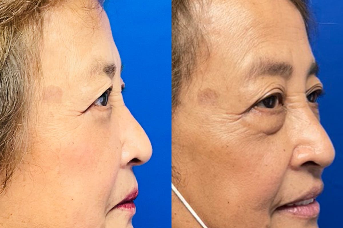 Eyelids Before & After Gallery - Patient 140792 - Image 2