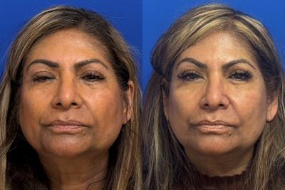 Facelift Before & After Gallery - Patient 357554 - Image 1