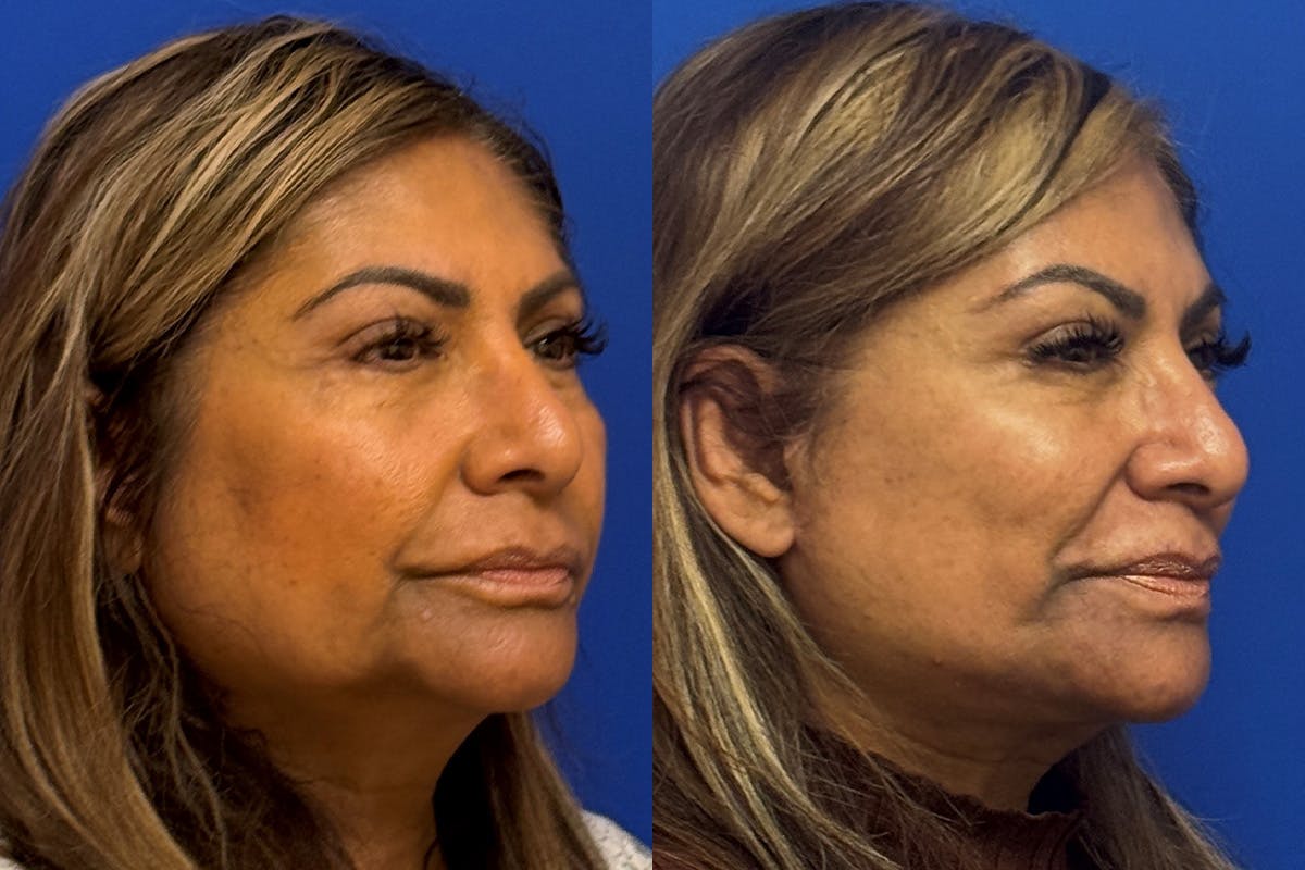 Neck Lift Before & After Gallery - Patient 154511 - Image 2