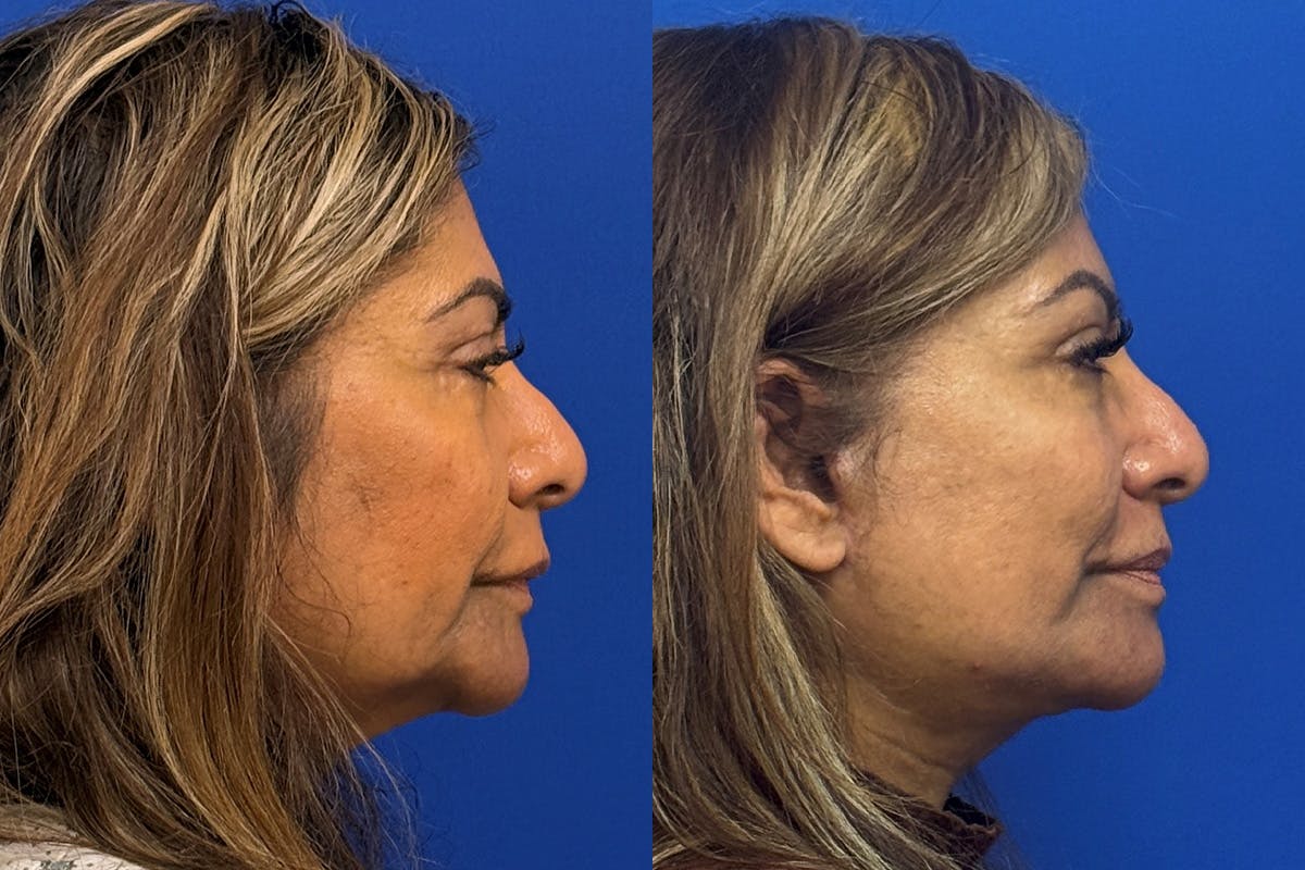 Neck Lift Before & After Gallery - Patient 154511 - Image 3
