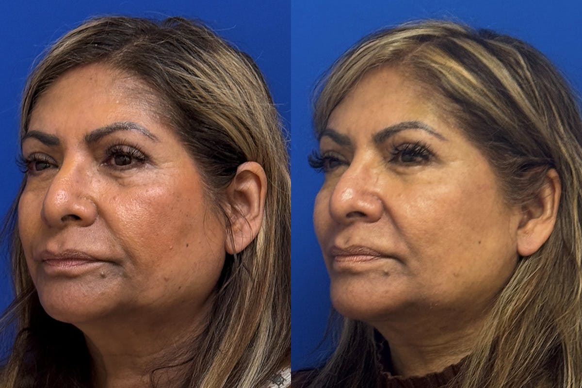 Neck Lift Before & After Gallery - Patient 154511 - Image 4