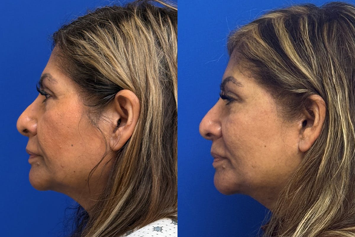 Neck Lift Before & After Gallery - Patient 154511 - Image 5