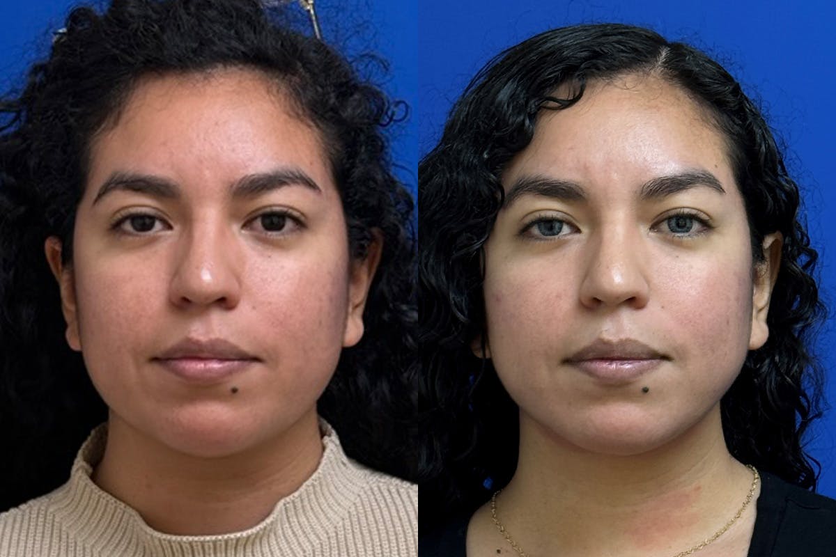 Facial Contouring / Submental Lipo Before & After Gallery - Patient 323449 - Image 1