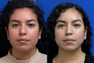Facial Contouring / Submental Lipo Before & After Gallery - Patient 323449 - Image 1
