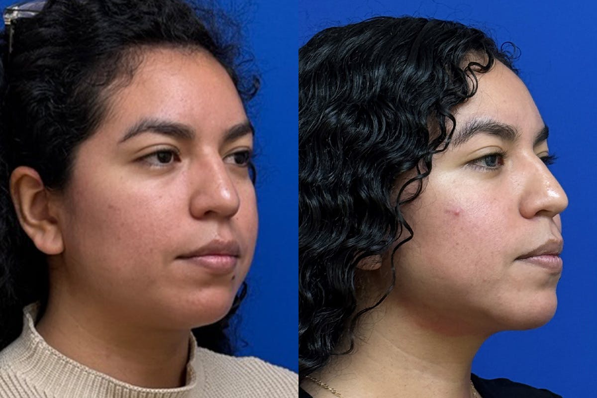 Facial Contouring / Submental Lipo Before & After Gallery - Patient 323449 - Image 2
