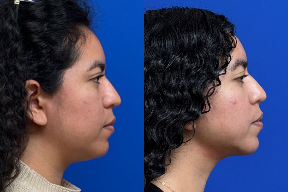 Facial Contouring / Submental Lipo Before & After Gallery - Patient 323449 - Image 3