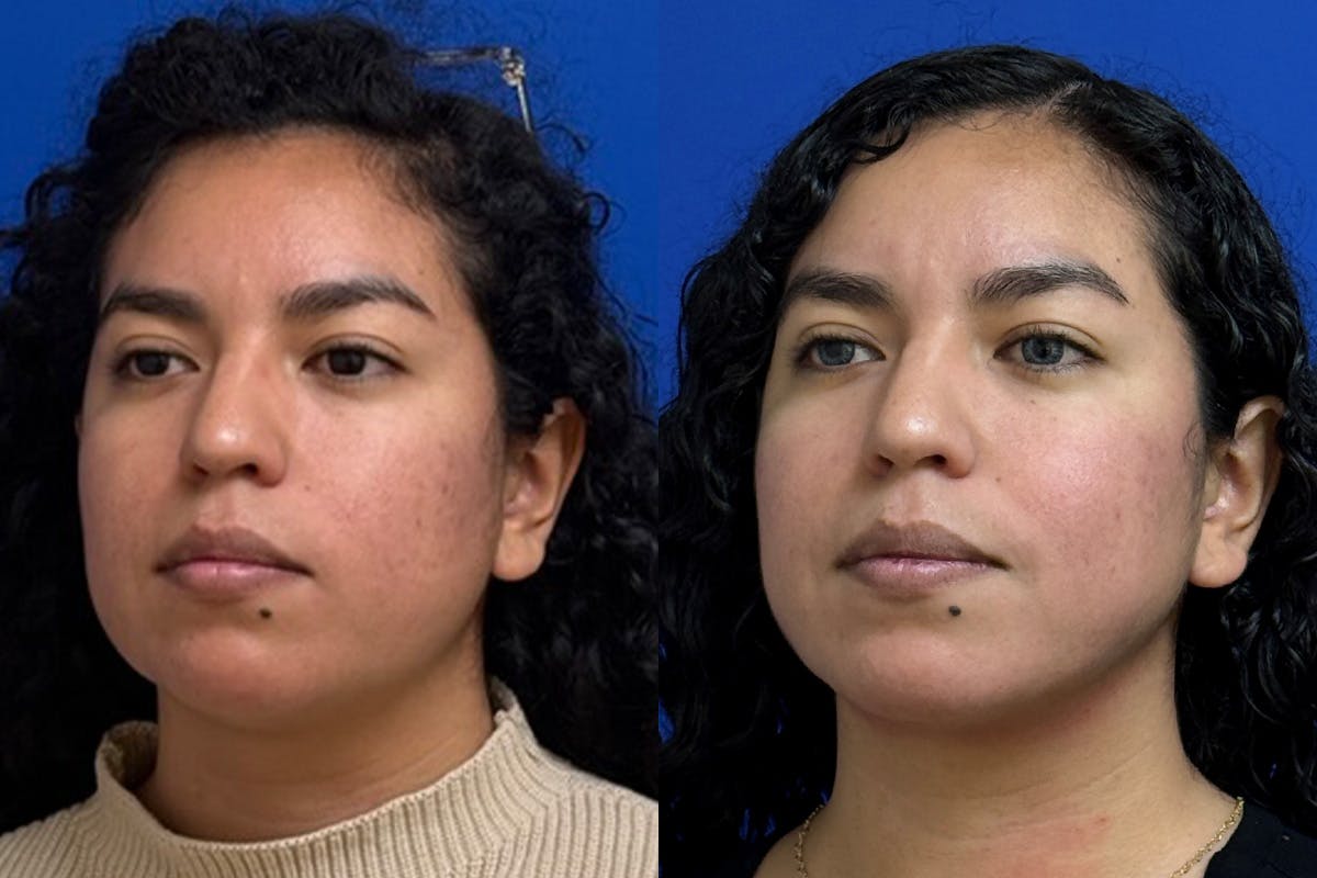 Facial Contouring / Submental Lipo Before & After Gallery - Patient 323449 - Image 4