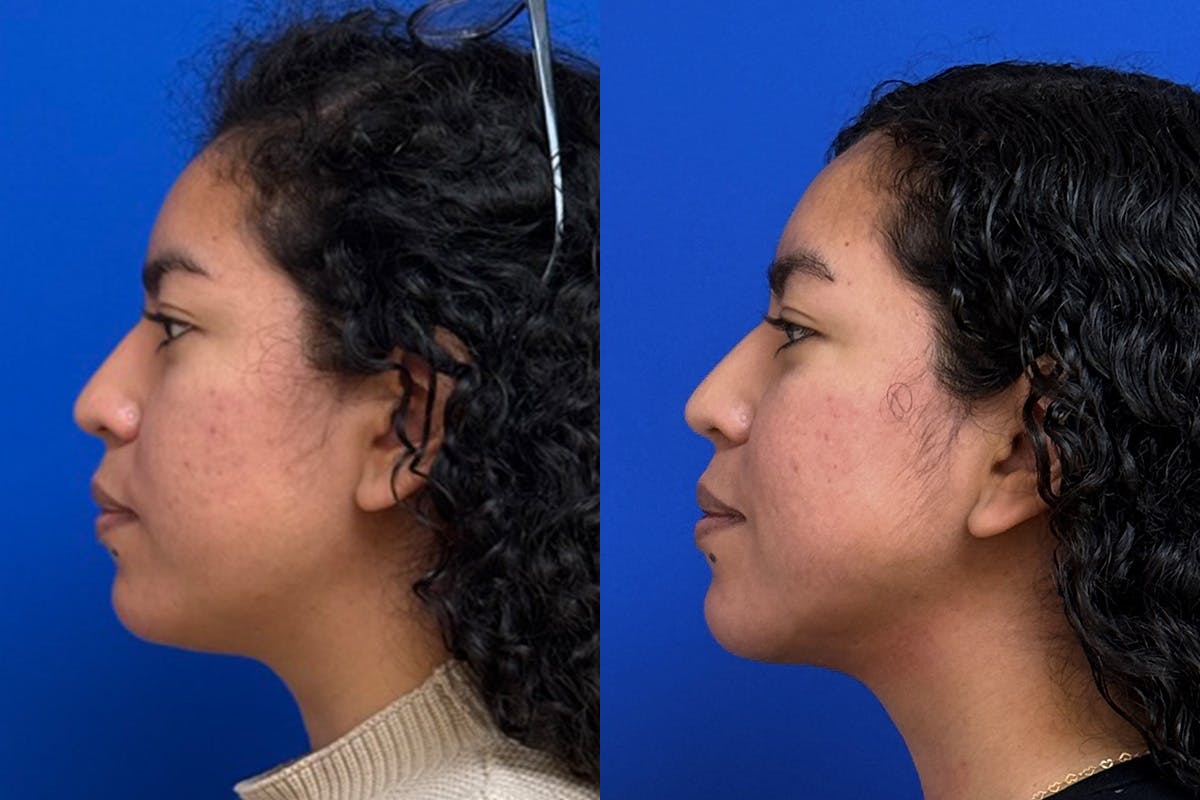 Facial Contouring / Submental Lipo Before & After Gallery - Patient 323449 - Image 5