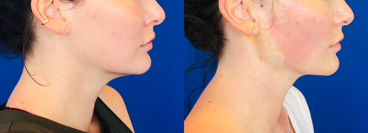 Facial Contouring / Submental Lipo Before & After Gallery - Patient 316646 - Image 1