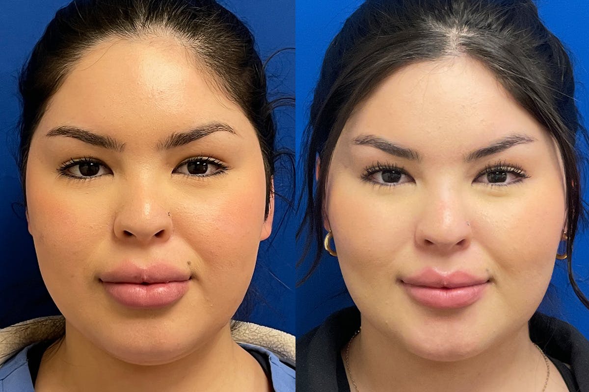 Facial Contouring / Submental Lipo Before & After Gallery - Patient 272509 - Image 1