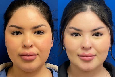 Facial Contouring / Submental Lipo Before & After Gallery - Patient 272509 - Image 1