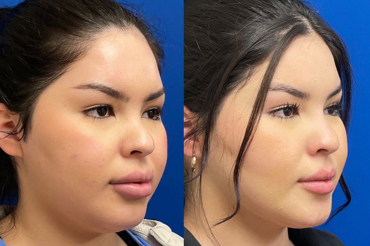 Facial Contouring / Submental Lipo Before & After Gallery - Patient 272509 - Image 2