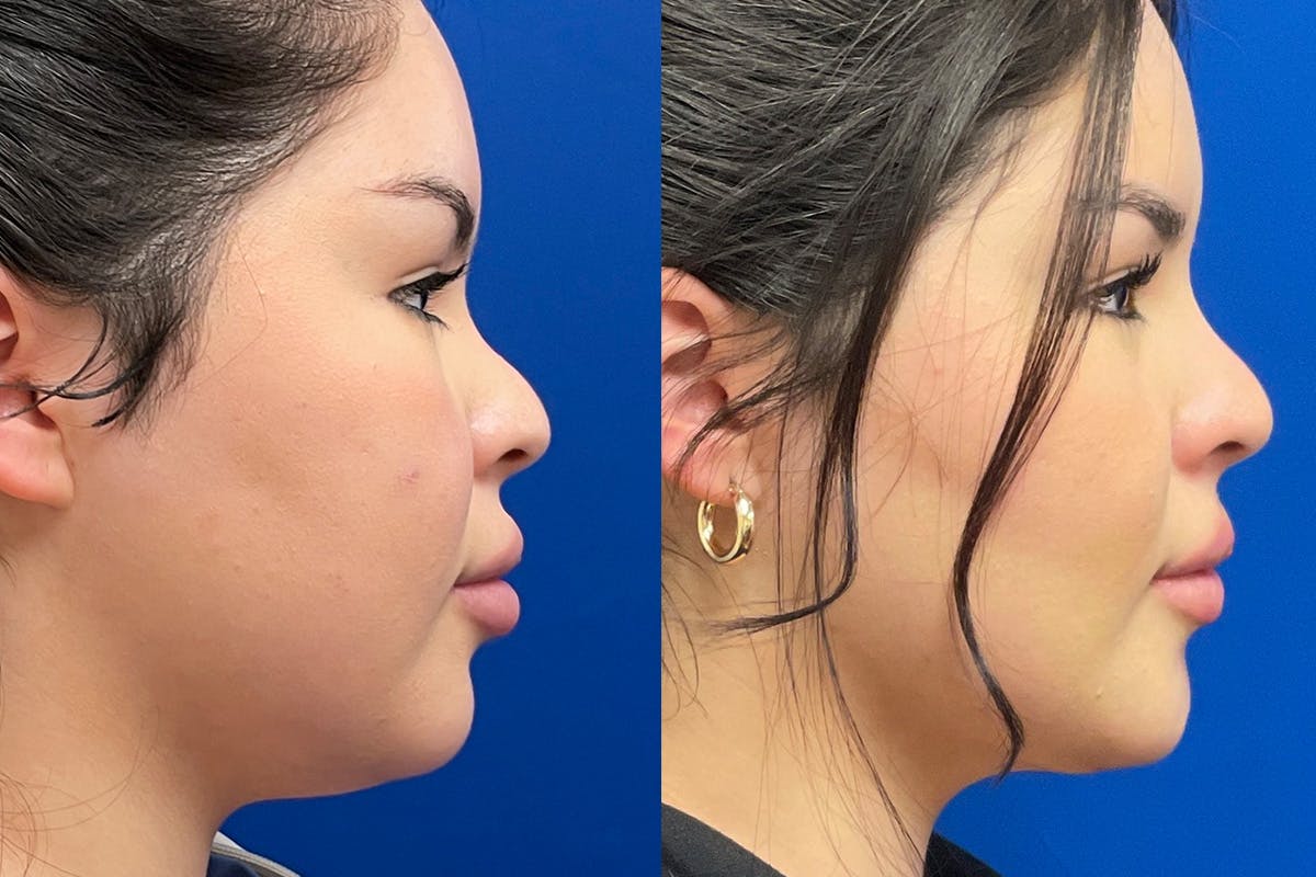 Facial Contouring / Submental Lipo Before & After Gallery - Patient 272509 - Image 3